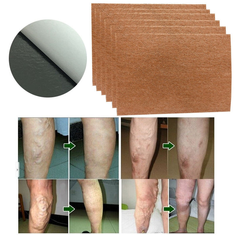 Varicose Veins Treatment Patches